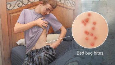 bed bug bites